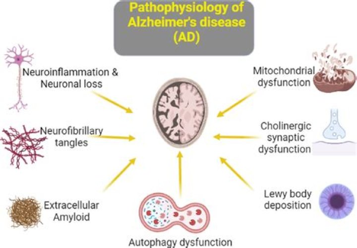 Overlap between pathology of Alzheimer disease and vascular dementia - ePrints